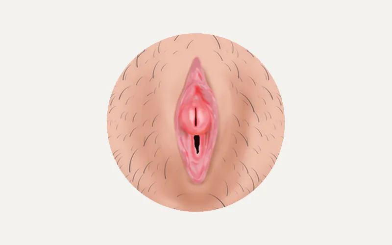 The companion illustration of the same anatomy, drawn to show changed tissue for side-by-side comparison